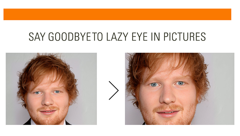 How To Fix Lazy Eye In Pictures